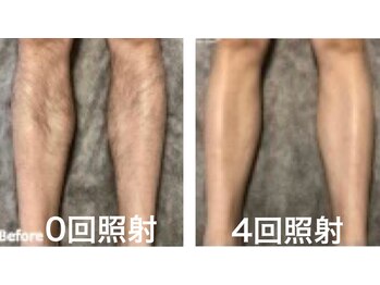 アンジュディ(A'nJUDY)/脱毛　ビフォーアフター