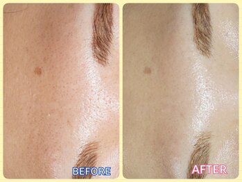 マニル アンド ネトラ(manil & netola)/眉間やおでこの毛穴が詰まりも！