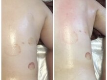 ビストオリエンタル(BST.oriental)/スライドカッピング効果