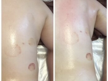 ビストオリエンタル(BST.oriental)/スライドカッピング効果