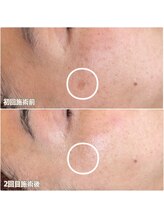 クラルス(clarus)/最新美容機器光フェイシャル