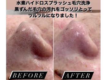 煌(kirameki)/感動毛穴洗浄コース