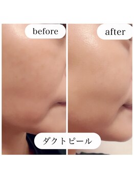 アウラ(AURA)/ダクトピールで毛穴、シミ撲滅!