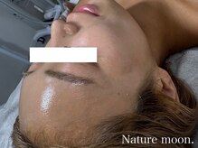 ナチュールムーン(Nature moon.)/ハーブピーリング　after