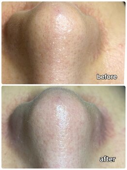 ハロースック 六本木(Hellossook)/アクアピール毛穴