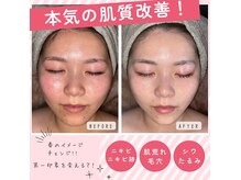 ブレアドール(Blair-Doll)の雰囲気(ニキビが1番のお悩みの方!ニキビ本気ケアがおススメです☆)