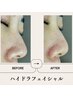 【たるみ・毛穴2ステップ】高出力サーマ×導入or毛穴洗浄で輪郭リフトケア