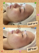 カロン(Kalon)/うるツヤ顔脱毛♪光フェイシャル