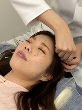 ハンドワーク(HANDWORK)/美容鍼