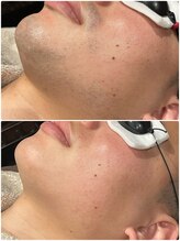 グロー(GLOW)/メンズヒゲ脱毛