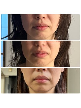 ボーンズ(BONES)/小顔矯正効果