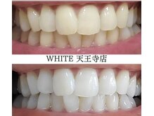 ホワイト 天王寺店(White)/Whitening症例before→after