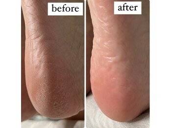 ビンナ 五反田店(Binna)/大人気足裏ケア