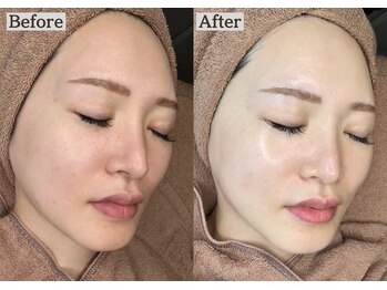 あすはれ/花粉・乾燥による揺らぎ肌に◎