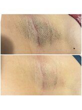 ボンダイボディー(Bondi Body)/脇脱毛5回目