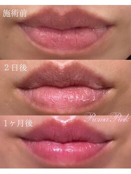 ハレとケ/話題のローマピンク