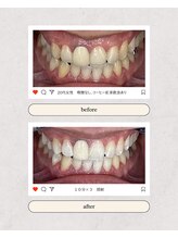 スマイルプライベートビューティサロン(Smile)/セルフホワイトニング（初回）