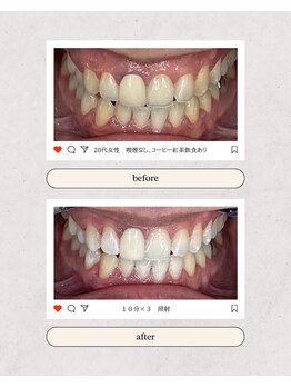 スマイルプライベートビューティサロン(Smile)/セルフホワイトニング(初回)