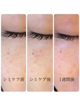 ギルドハナレ(GUILD HANARE)/"くすみ・シミ改善"