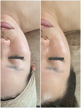 リノ(Lino)/毛穴開きにフェイシャルワックス