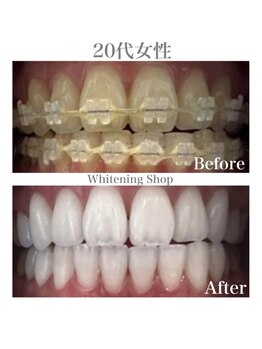 ホワイトニングショップ 広島廿日市店/before&after