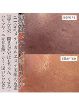 クラルテアンドコー(Salon Clarte&Co.)/韓国海洋性ハーブピーリング/3回
