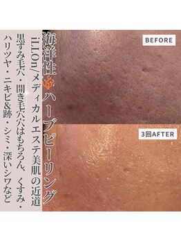 クラルテアンドコー(Salon Clarte&Co.)/韓国海洋性ハーブピーリング/3回