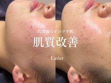ラティエ(Latier)/肌質改善ハーブピーリング