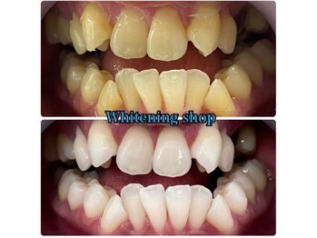 ホワイトニングショップ 船橋店/Before&After美白ホワイトニング