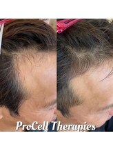 ユカリス(Yu.charis)/プロセル頭皮 before→after