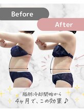 ミネット(minette)/脂肪冷却＊before→after