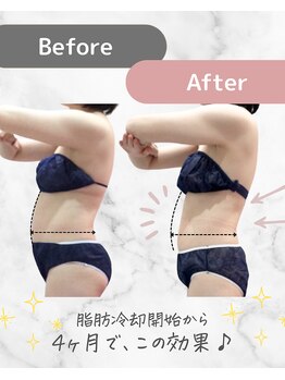 ミネット(minette)/脂肪冷却*before→after
