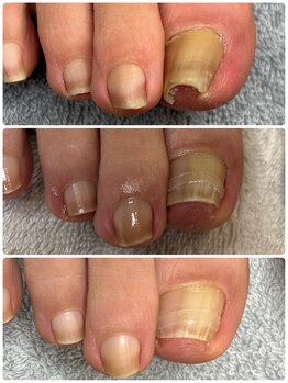 リゼラアンドコー 柏原店/巻き爪ケア途中経過