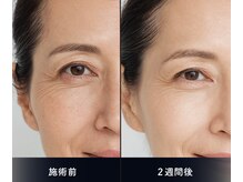 ソアン(Soin)/ダクトピール