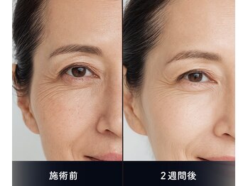 ソアン(Soin)/ダクトピール