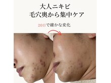 シェノン 赤坂大濠店の雰囲気(72時間持続型ニキビケア/20日後に確かな変化)