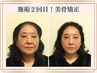 【50代からの諦めたるみを改善】メス不要でリフトアップ★美骨形成術×美肌
