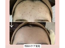 スキンハピネス(skinhappiness)/顔ハーブピーリング（ハード）