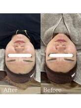 ラ フルール(La Fleur)/エアバリフェイシャル