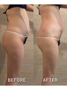 オーロラ(Aurora)/お腹周り2回目痩身