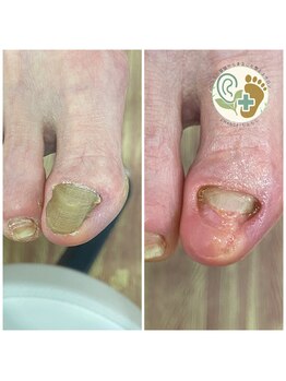 チェンジ(CHANGE)/変形爪ケアサービス