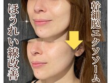 フェイスプラスリフ(FACE+RiF)/お悩みによりオーダーメイド施術