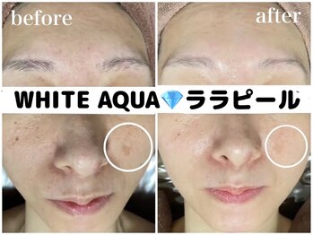 ホワイトアクア 柏店(WHITE AQUA)/ララピール/しみケア/くすみ