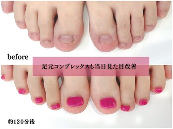 インブロッサム(imblossom)の写真/【足の深爪にお悩みの方必見！当日からサンダルが履ける見た目に◎悩みに寄り添い丁寧にサポート☆】