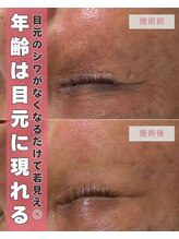 ジーニー(genie)/目元のシワ改善