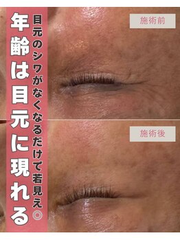 ジーニー(genie)/目元のシワ改善