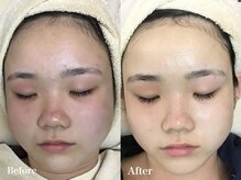 ラウレア 西条店(LAULEA)/ハーブピーリングbefore/after