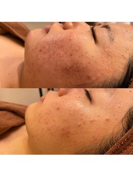 ウェルビーイング(well-being)/大泉学園 ニキビケア