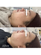 ラ フルール(La Fleur)/エアバリフェイシャル