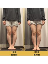 ベル/【20代会員様】O脚矯正の変化